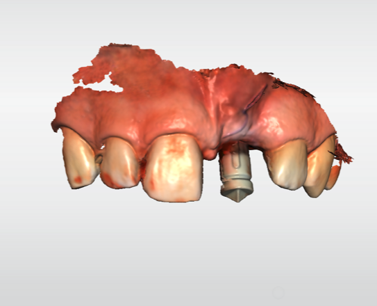 Implantología Clínica dental en Pacífico Pradíes & Laffond