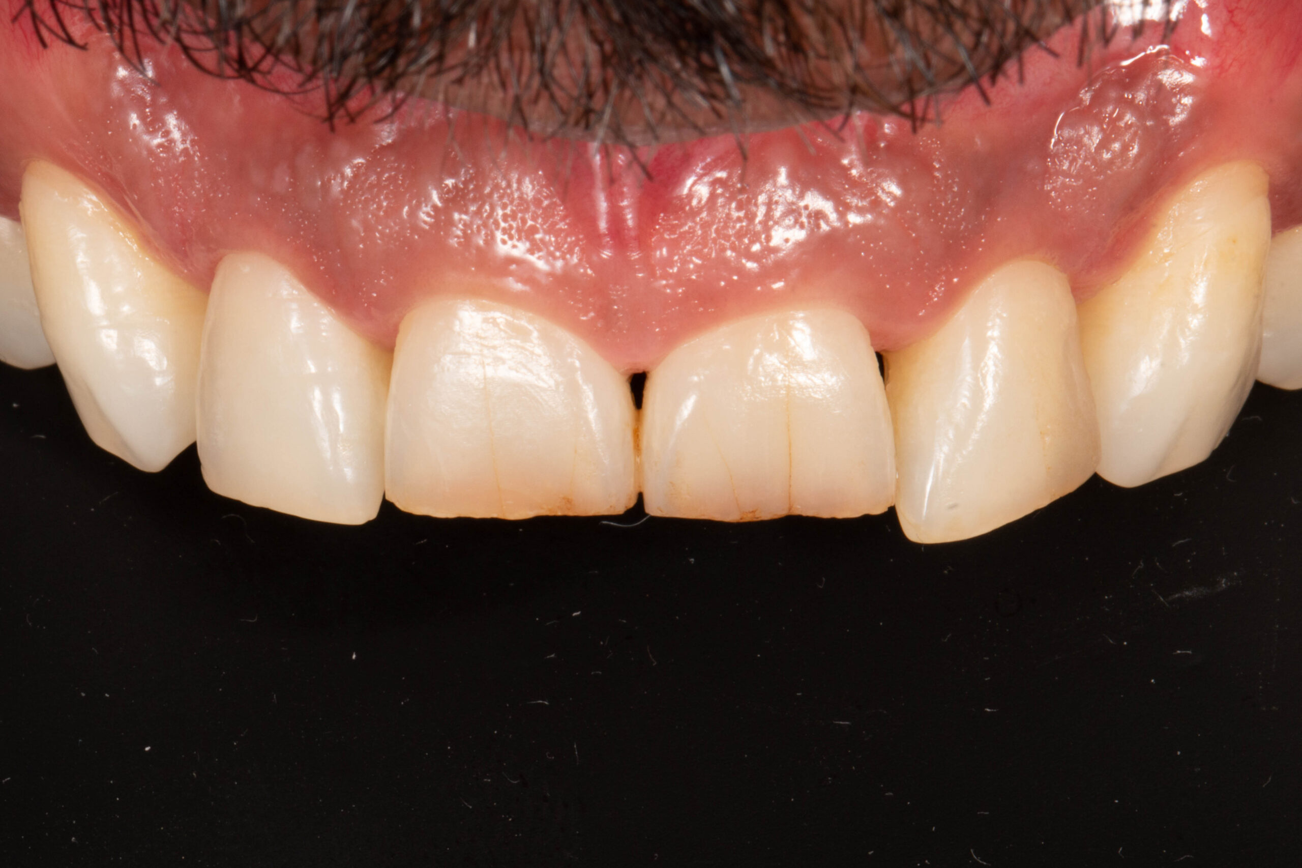 Casos Clínica dental en Pacífico Pradíes & Laffond