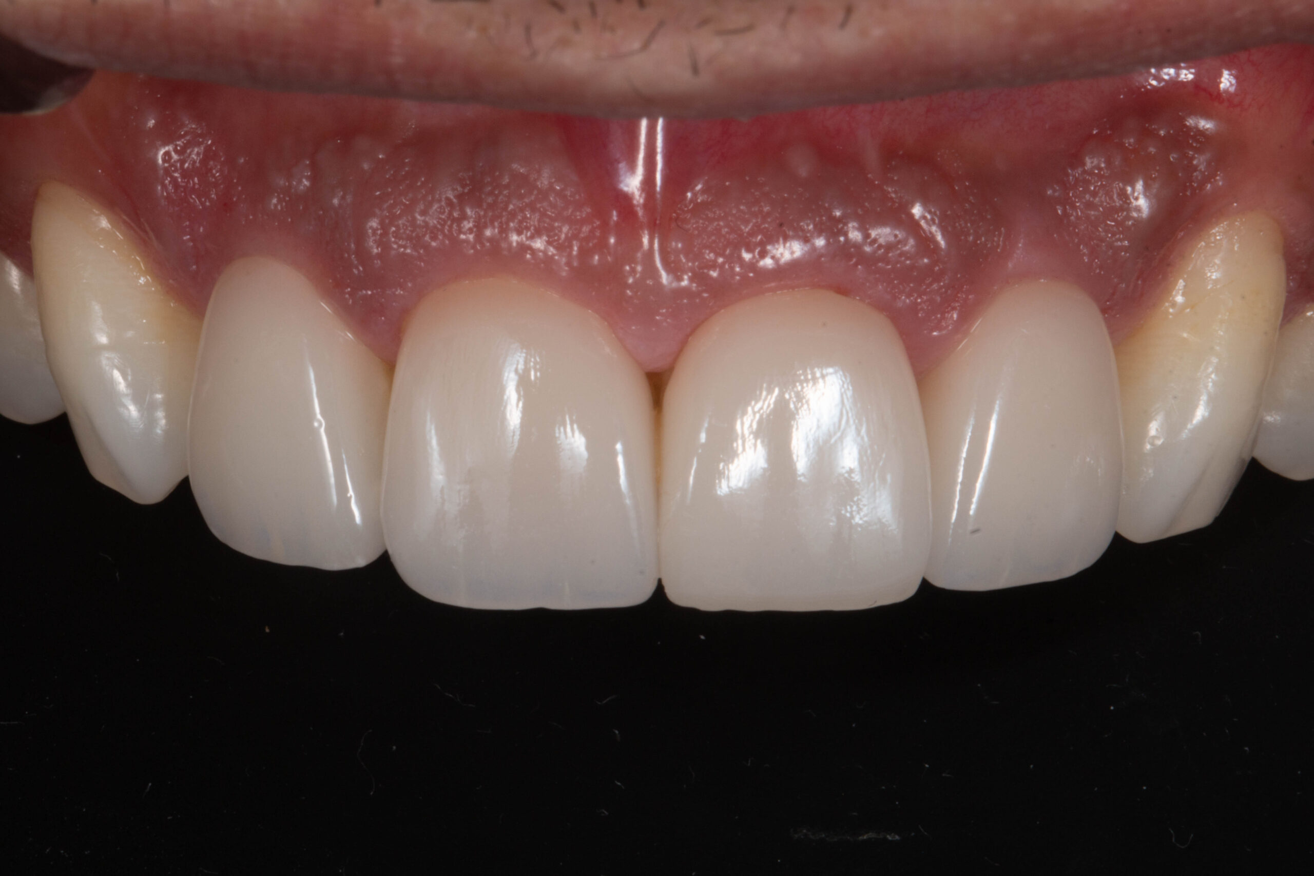 Casos Clínica dental en Pacífico Pradíes & Laffond