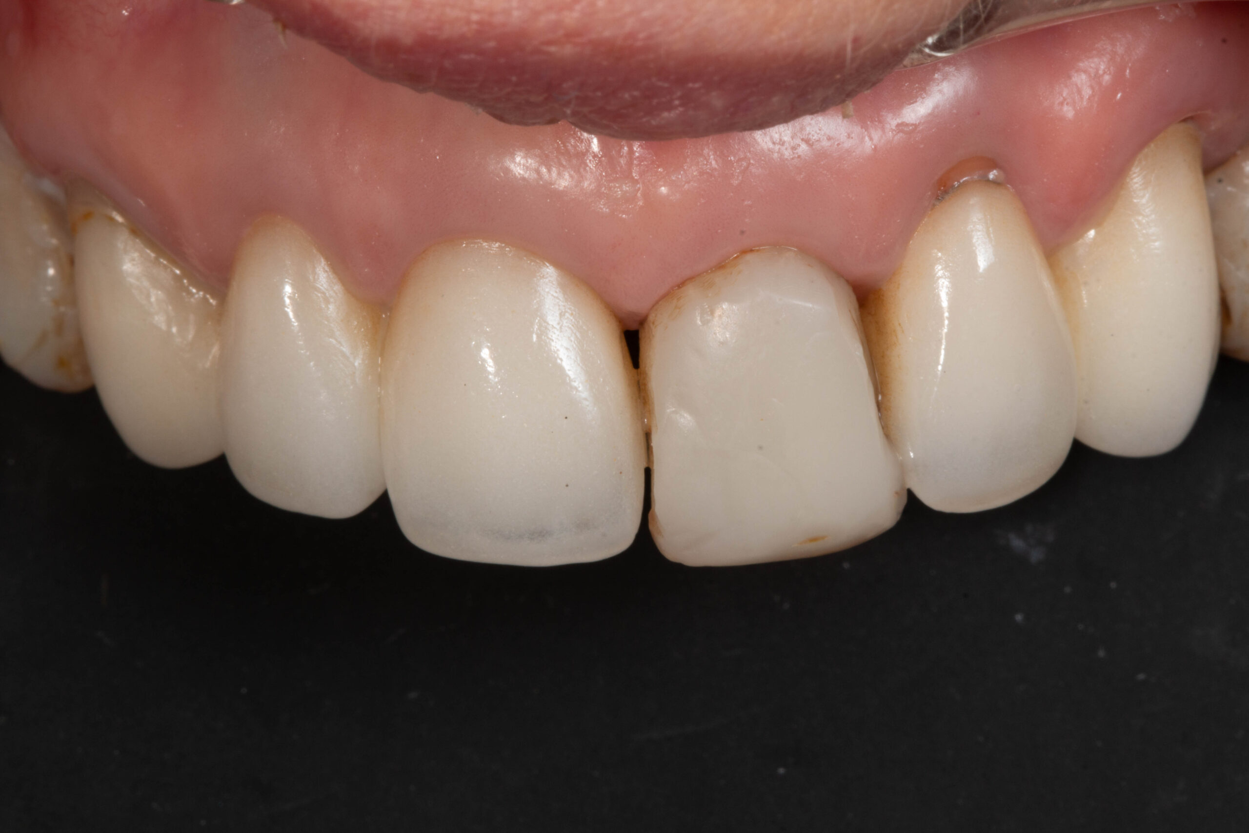 Casos Clínica dental en Pacífico Pradíes & Laffond