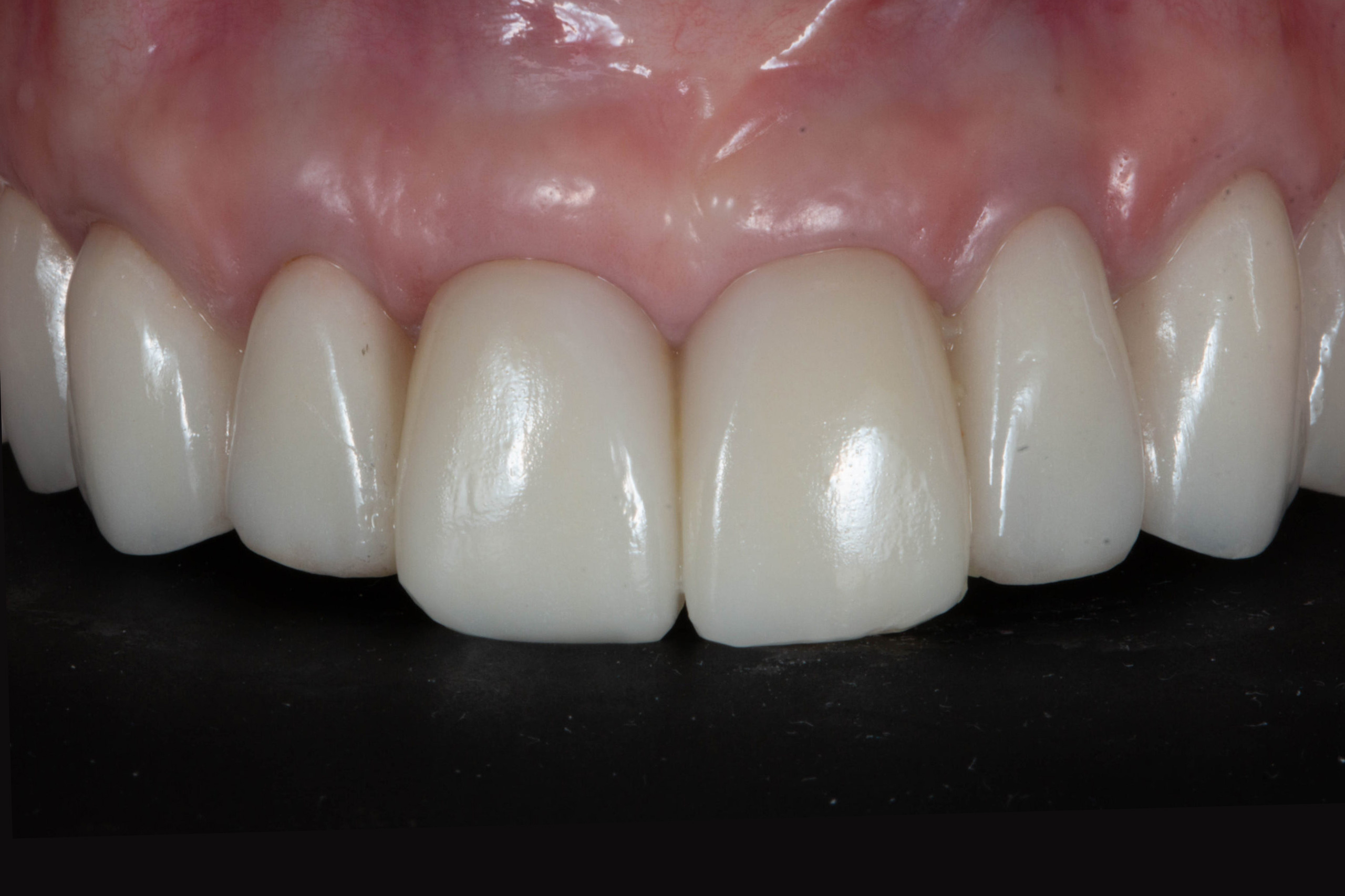 Casos Clínica dental en Pacífico Pradíes & Laffond