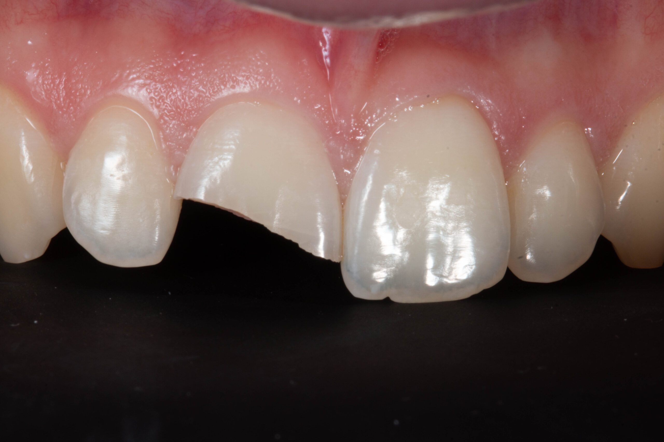 Casos Clínica dental en Pacífico Pradíes & Laffond