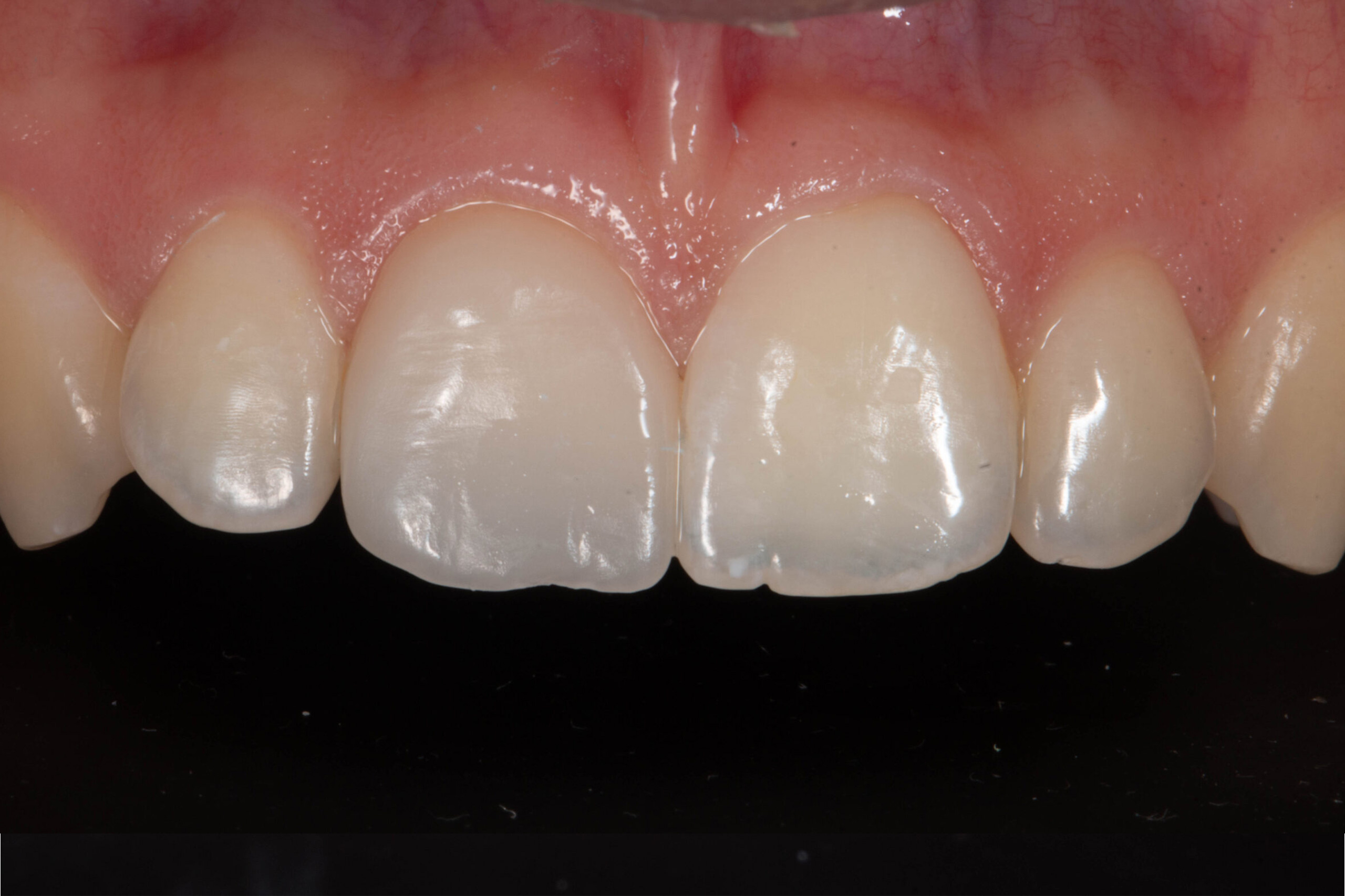 Casos Clínica dental en Pacífico Pradíes & Laffond