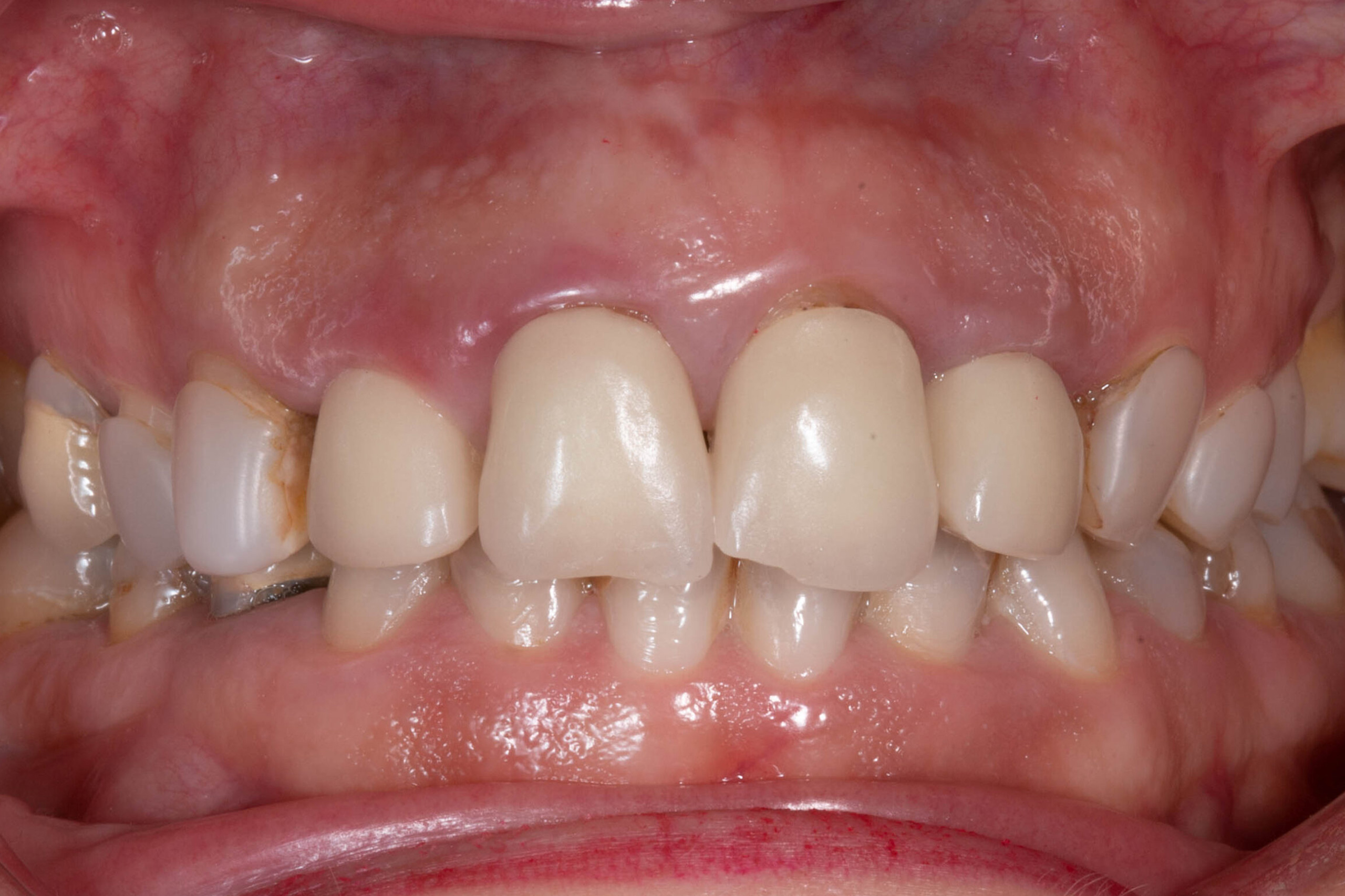 Casos Clínica dental en Pacífico Pradíes & Laffond